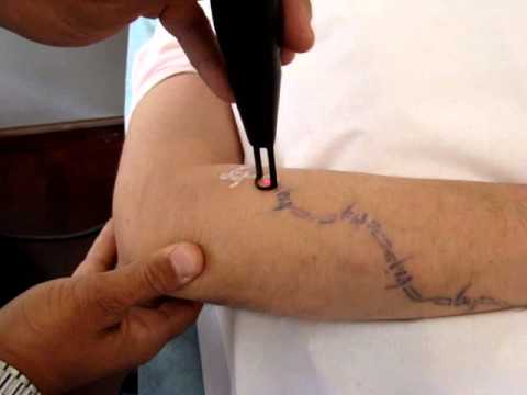 Videos del Taller y Workshop sobre uso del Lser Spectra en borramiento de tatuajes, manchas, onicomicosis y rejuvenecimiento facial.